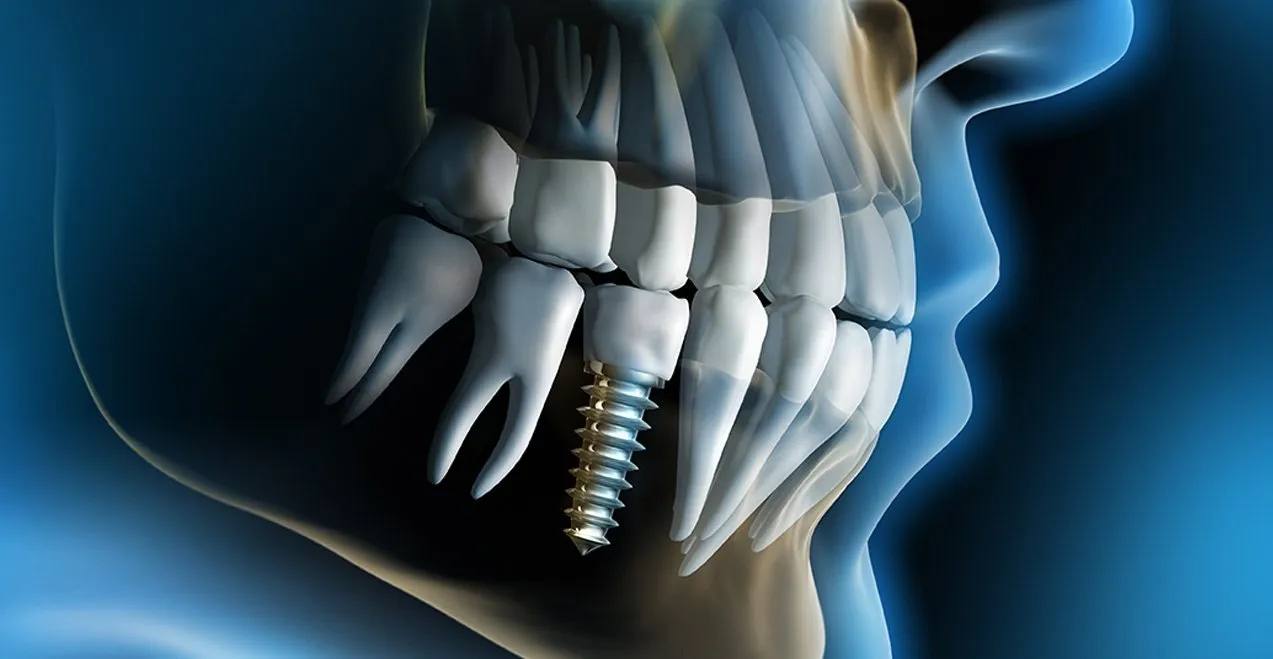 Illustrazione di un impianto dentale inserito nell’osso della mandibola